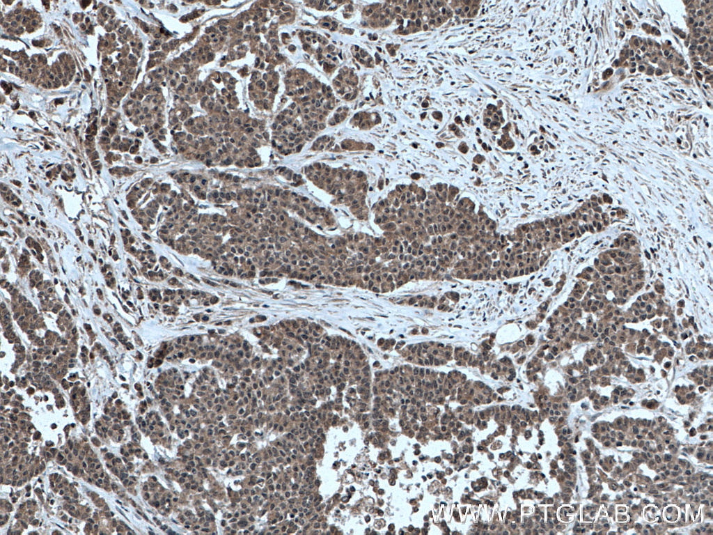 Immunohistochemistry (IHC) staining of human colon cancer tissue using TRIM21 Polyclonal antibody (12108-1-AP)