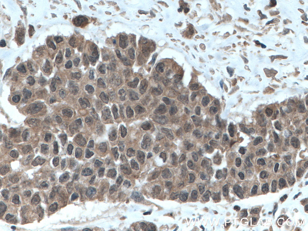 Immunohistochemistry (IHC) staining of human colon cancer tissue using TRIM21 Polyclonal antibody (12108-1-AP)
