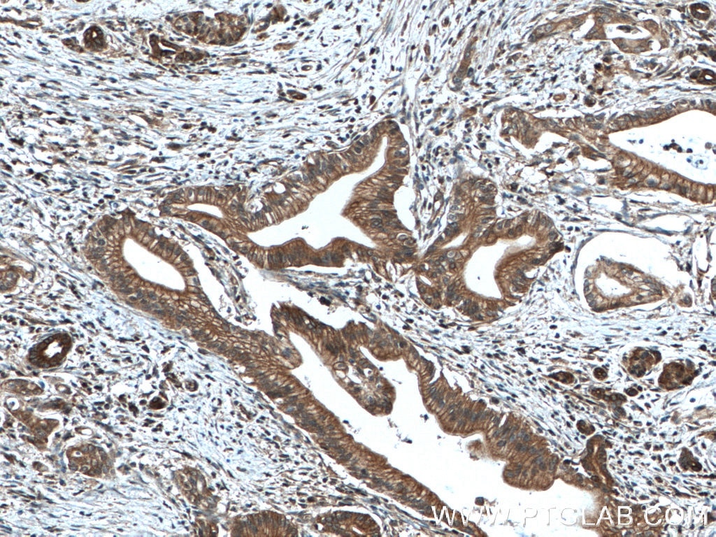 Immunohistochemistry (IHC) staining of human pancreas cancer tissue using TRIM21 Polyclonal antibody (12108-1-AP)