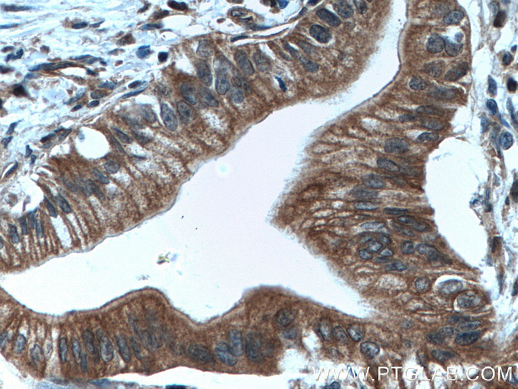 Immunohistochemistry (IHC) staining of human pancreas cancer tissue using TRIM21 Polyclonal antibody (12108-1-AP)