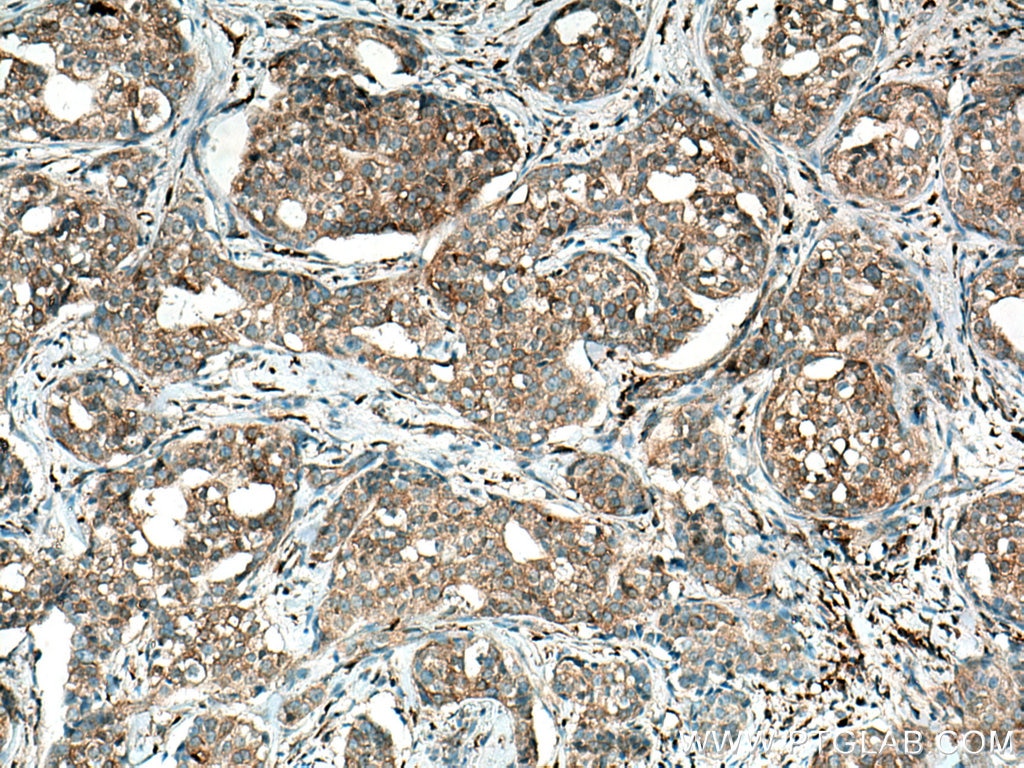 Immunohistochemistry (IHC) staining of human breast cancer tissue using TRIM21 Monoclonal antibody (67136-1-Ig)