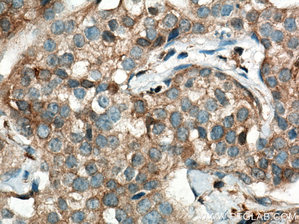 Immunohistochemistry (IHC) staining of human breast cancer tissue using TRIM21 Monoclonal antibody (67136-1-Ig)