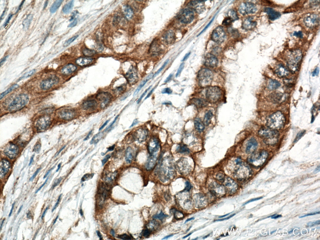 Immunohistochemistry (IHC) staining of human pancreas cancer tissue using TRIM21 Monoclonal antibody (67136-1-Ig)