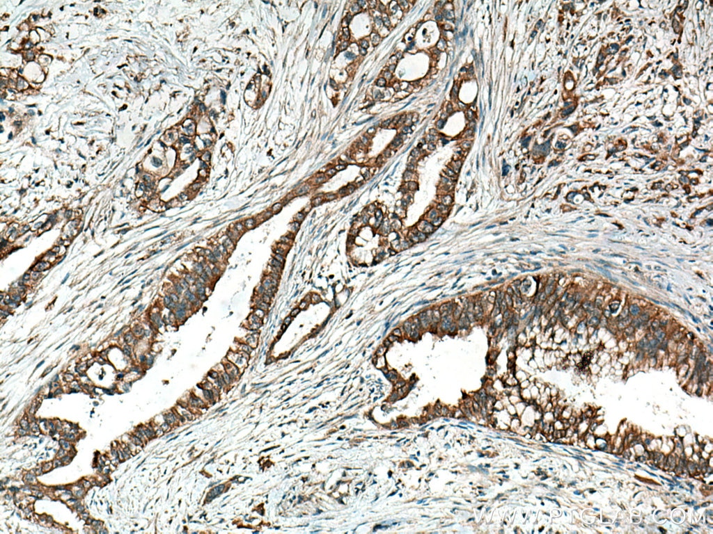 Immunohistochemistry (IHC) staining of human pancreas cancer tissue using TRIM21 Monoclonal antibody (67136-1-Ig)
