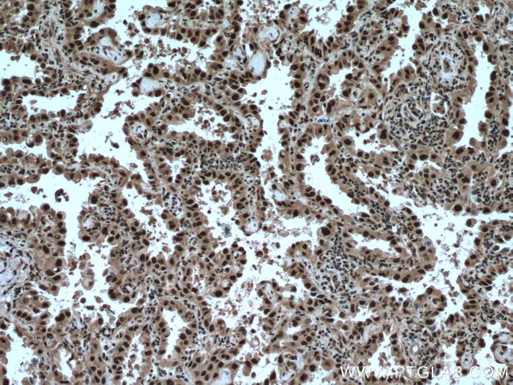IHC staining of human lung cancer using 13744-1-AP