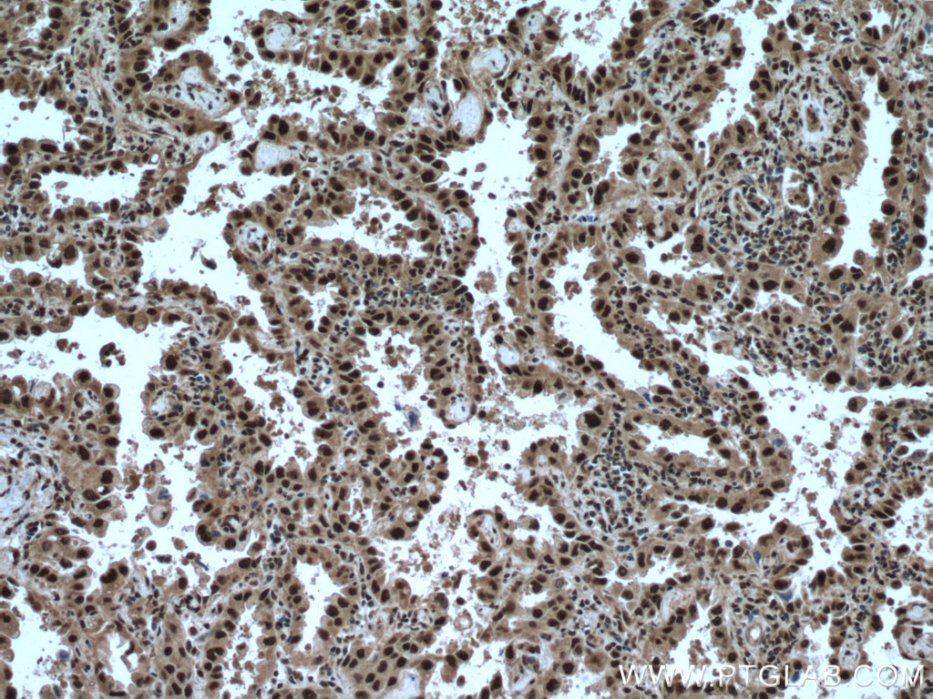 Immunohistochemistry (IHC) staining of human lung cancer tissue using TRIM22 Polyclonal antibody (13744-1-AP)