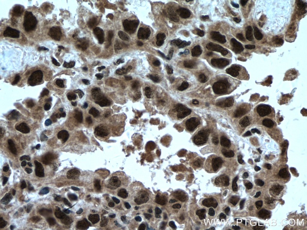 Immunohistochemistry (IHC) staining of human lung cancer tissue using TRIM22 Polyclonal antibody (13744-1-AP)
