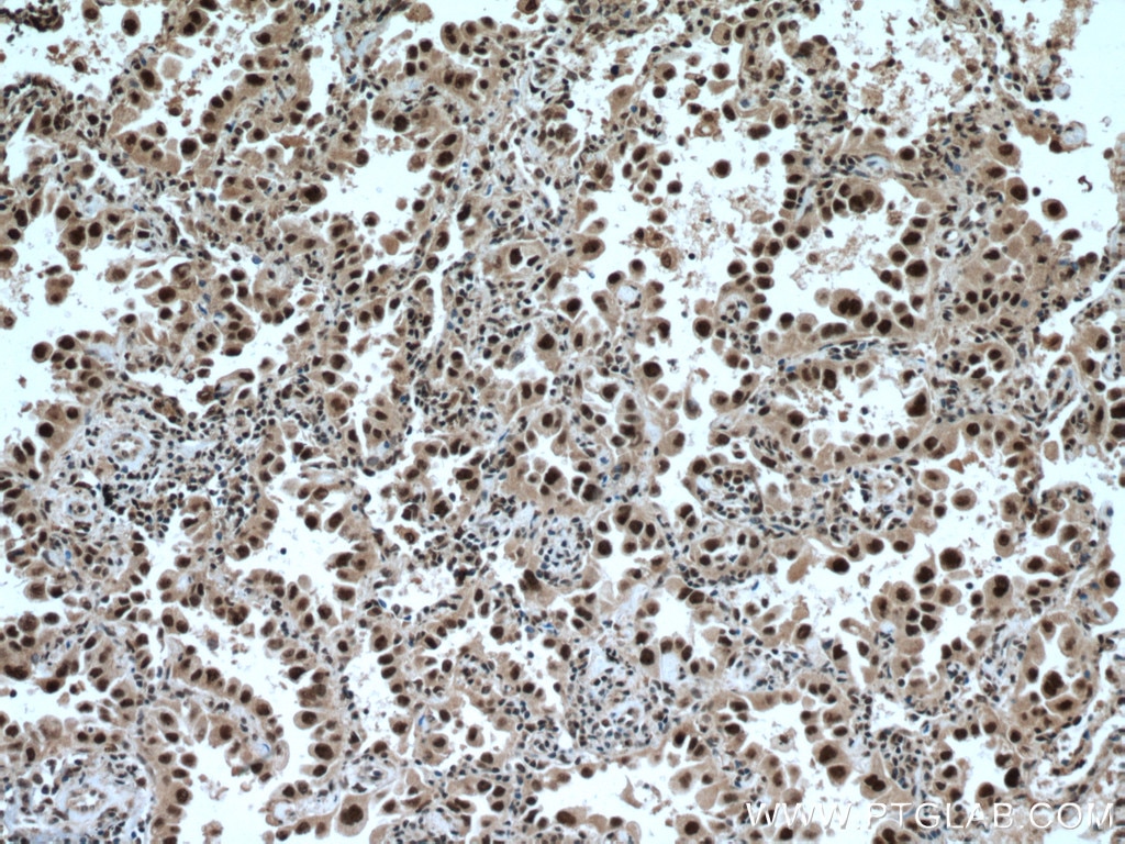 Immunohistochemistry (IHC) staining of human lung cancer tissue using TRIM22 Polyclonal antibody (13744-1-AP)