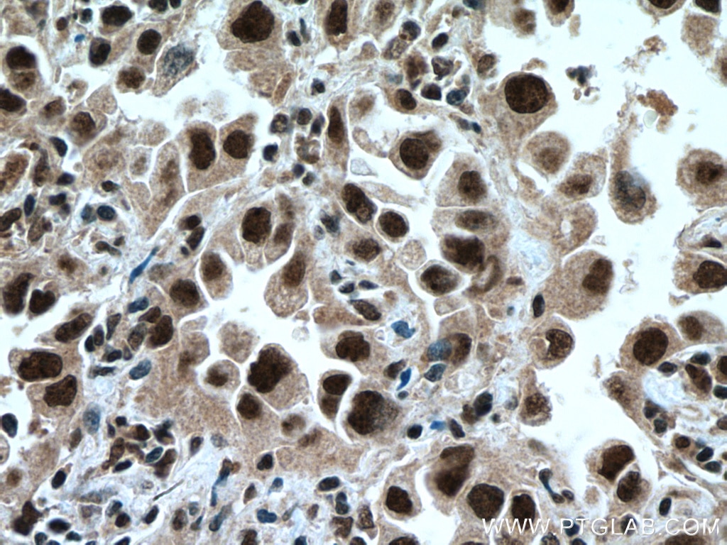 Immunohistochemistry (IHC) staining of human lung cancer tissue using TRIM22 Polyclonal antibody (13744-1-AP)