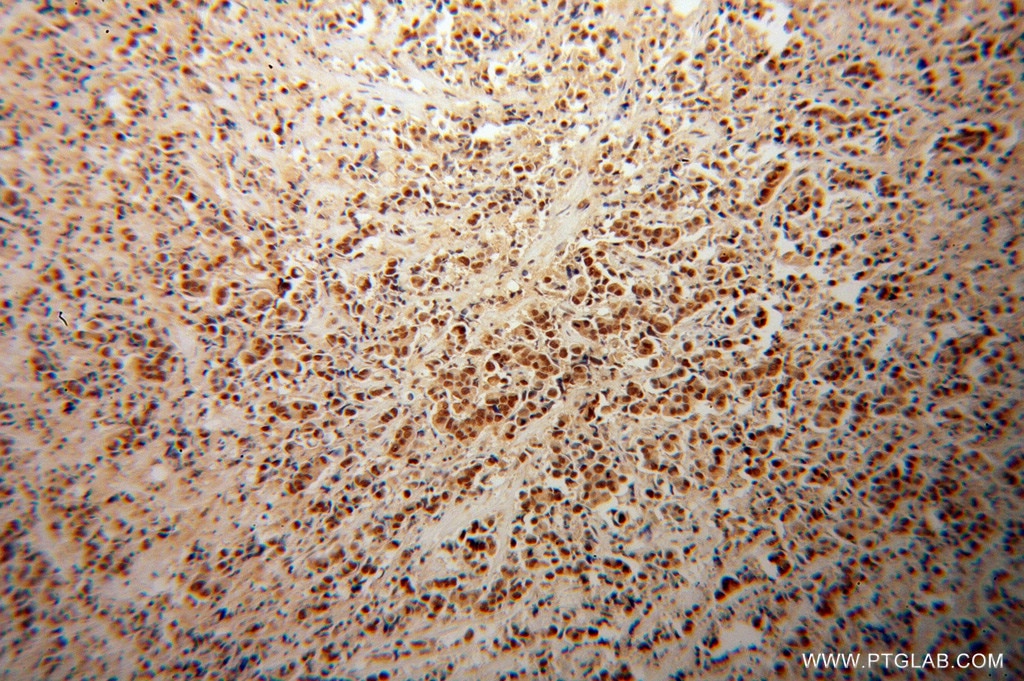 Immunohistochemistry (IHC) staining of human prostate cancer tissue using TRIM24 Polyclonal antibody (14208-1-AP)
