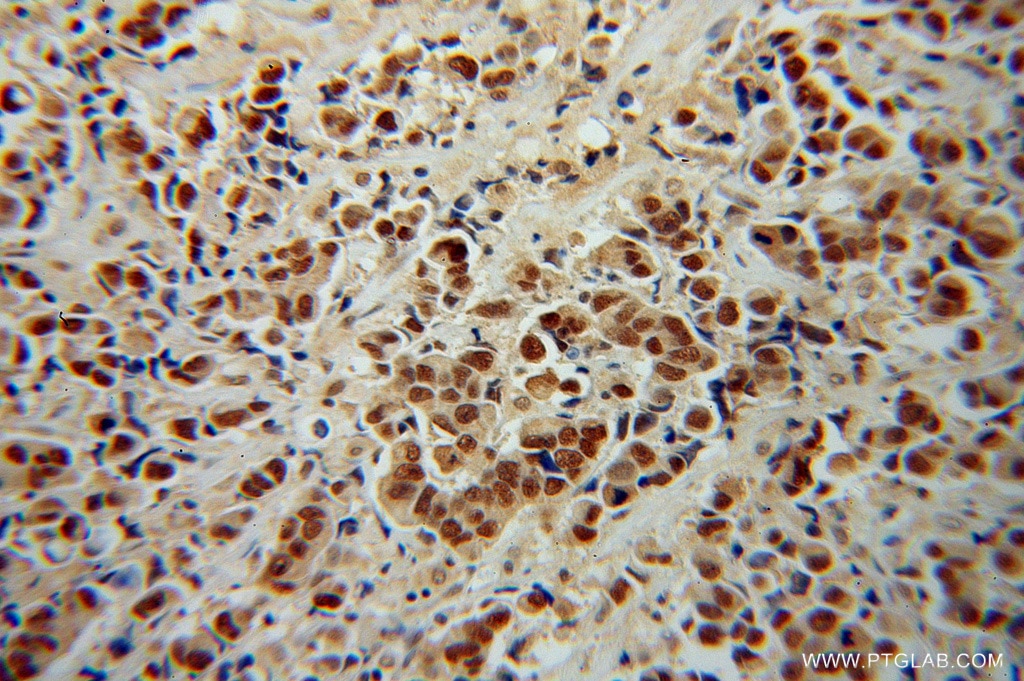 Immunohistochemistry (IHC) staining of human prostate cancer tissue using TRIM24 Polyclonal antibody (14208-1-AP)