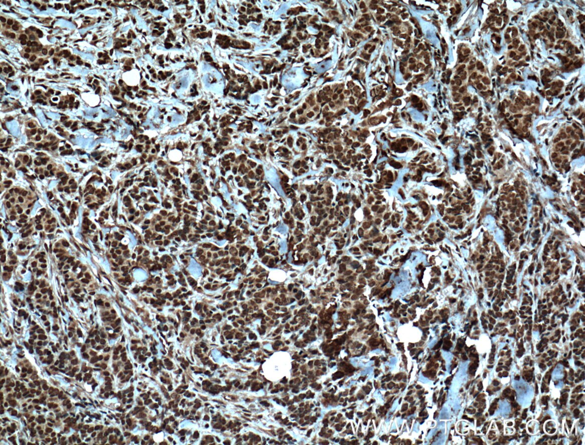 Immunohistochemistry (IHC) staining of human breast cancer tissue using TRIM24 Monoclonal antibody (66324-1-Ig)