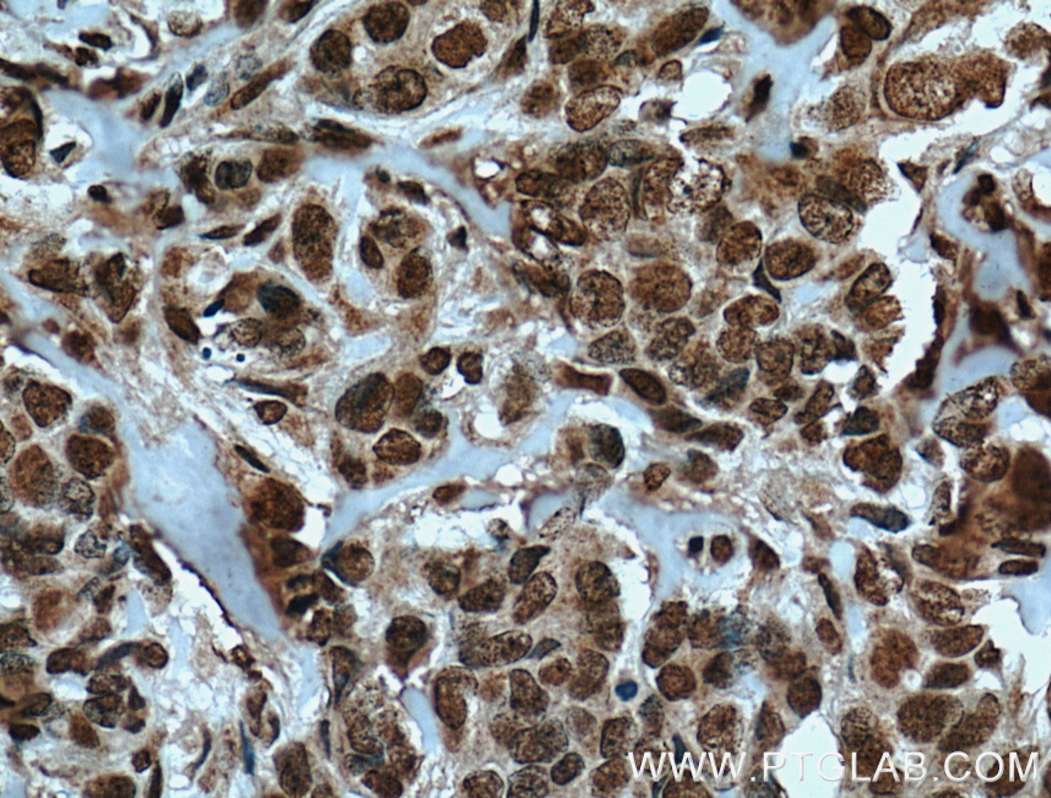 Immunohistochemistry (IHC) staining of human breast cancer tissue using TRIM24 Monoclonal antibody (66324-1-Ig)