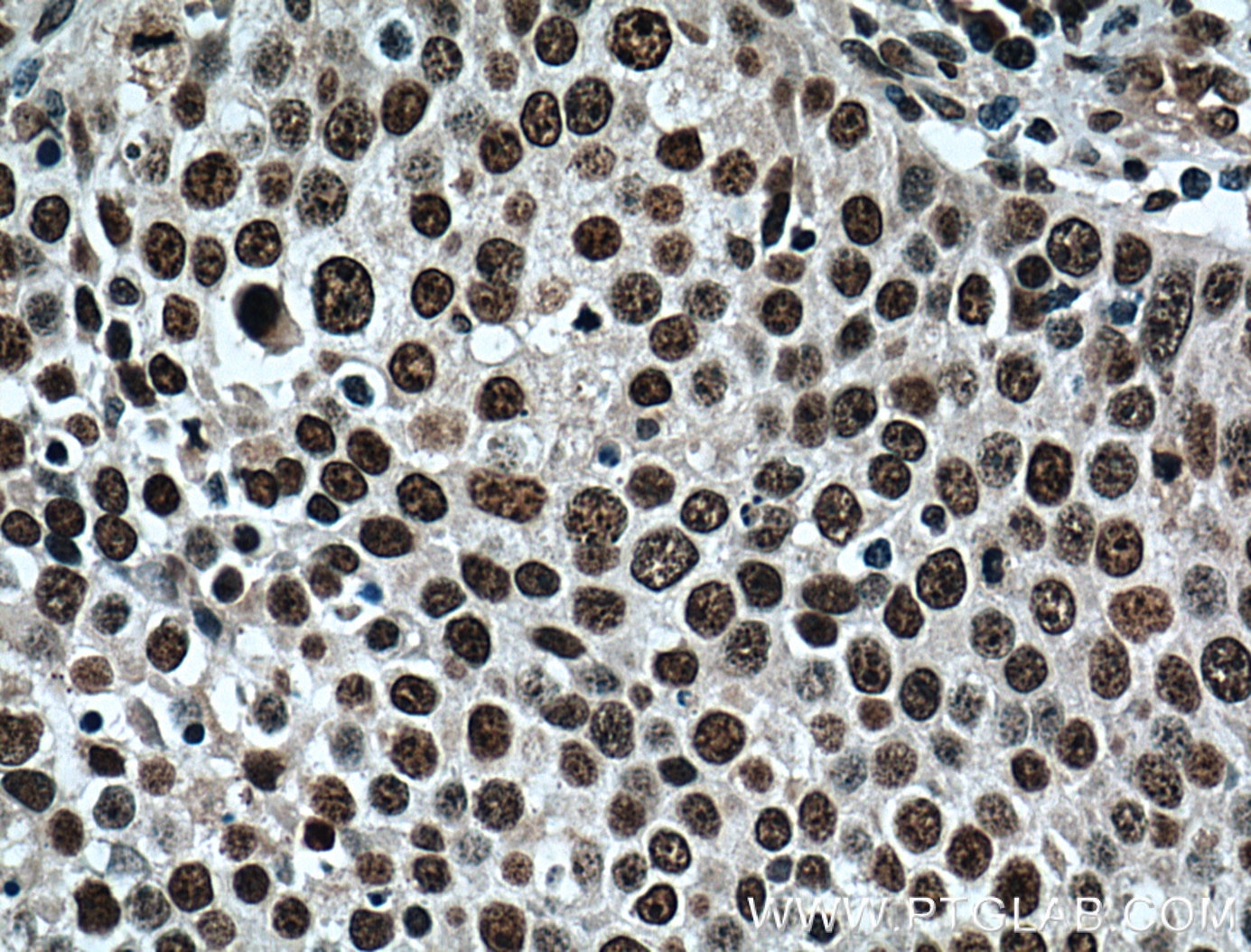Immunohistochemistry (IHC) staining of human lung cancer tissue using TRIM24 Monoclonal antibody (66324-1-Ig)