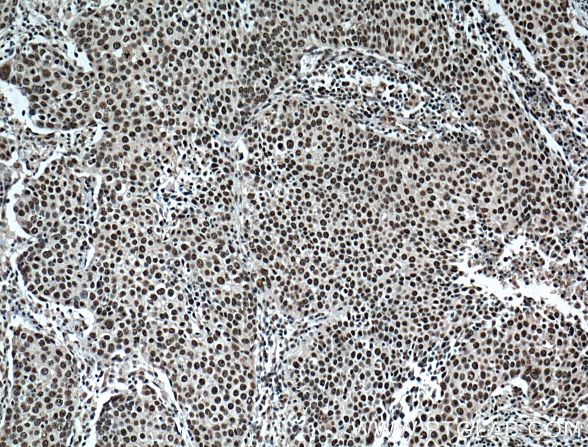 Immunohistochemistry (IHC) staining of human lung cancer tissue using TRIM24 Monoclonal antibody (66324-1-Ig)