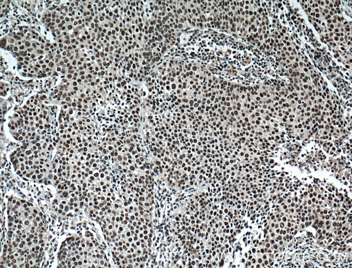 IHC staining of human lung cancer using 66324-1-Ig