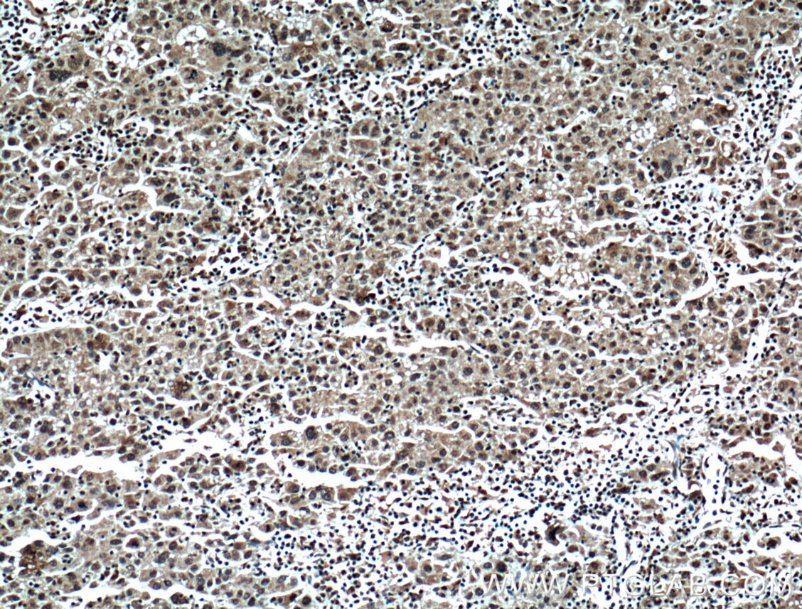 Immunohistochemistry (IHC) staining of human liver cancer tissue using TRIM24 Monoclonal antibody (66324-1-Ig)