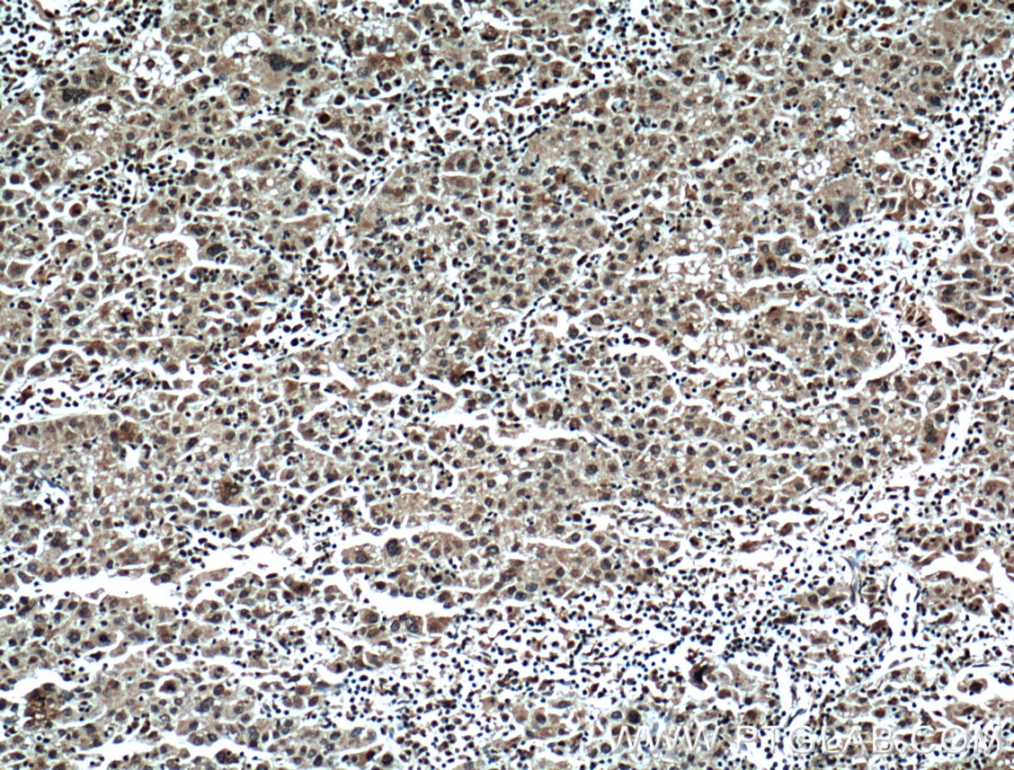 IHC staining of human liver cancer using 66324-1-Ig