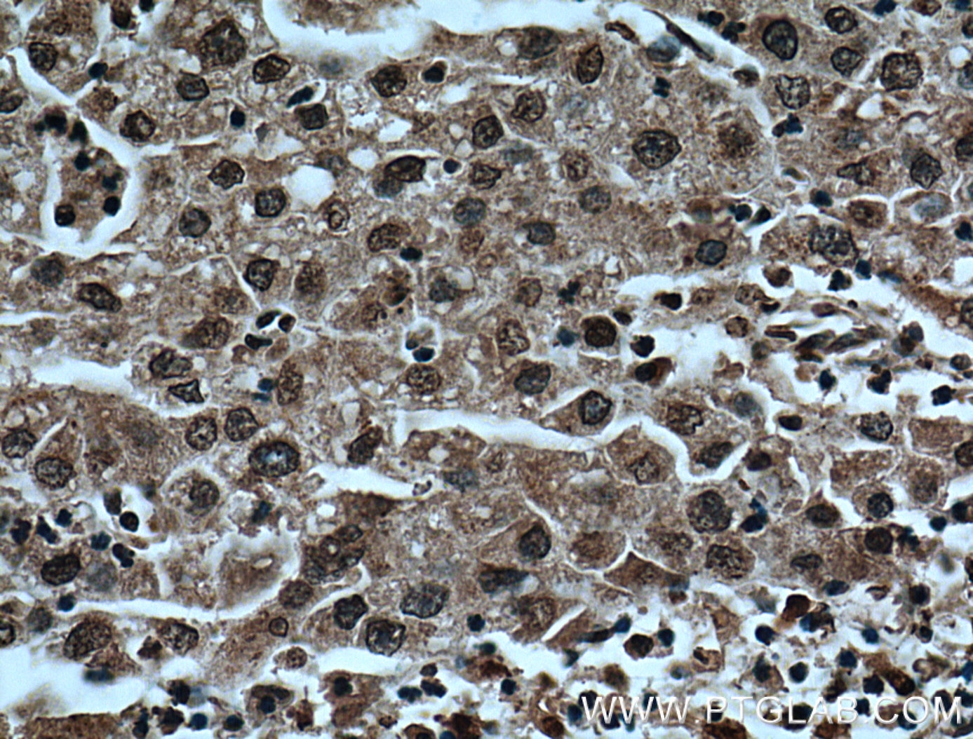 Immunohistochemistry (IHC) staining of human liver cancer tissue using TRIM24 Monoclonal antibody (66324-1-Ig)