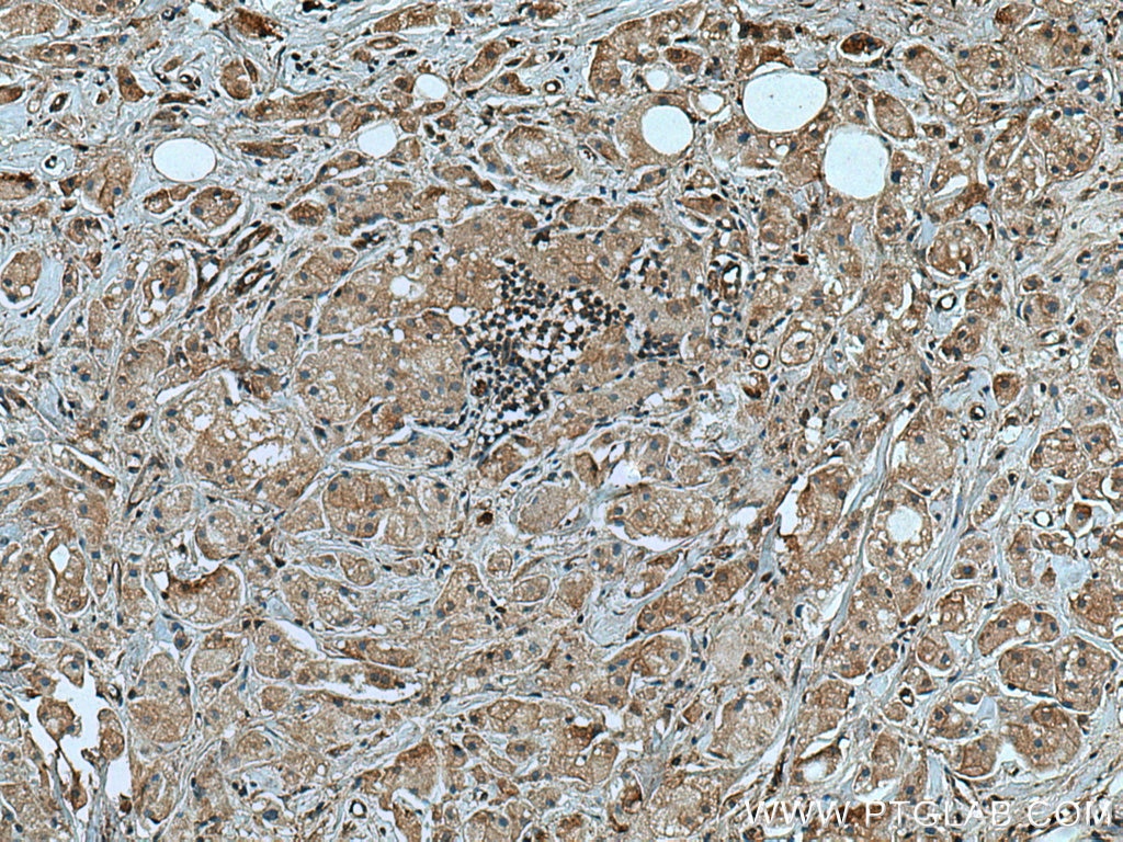 Immunohistochemistry (IHC) staining of human breast cancer tissue using TRIM25 Monoclonal antibody (67314-1-Ig)