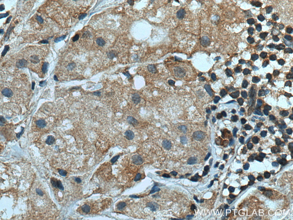 Immunohistochemistry (IHC) staining of human breast cancer tissue using TRIM25 Monoclonal antibody (67314-1-Ig)
