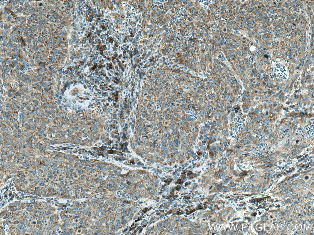 Immunohistochemistry (IHC) staining of human cervical cancer tissue using TRIM25 Monoclonal antibody (67314-1-Ig)