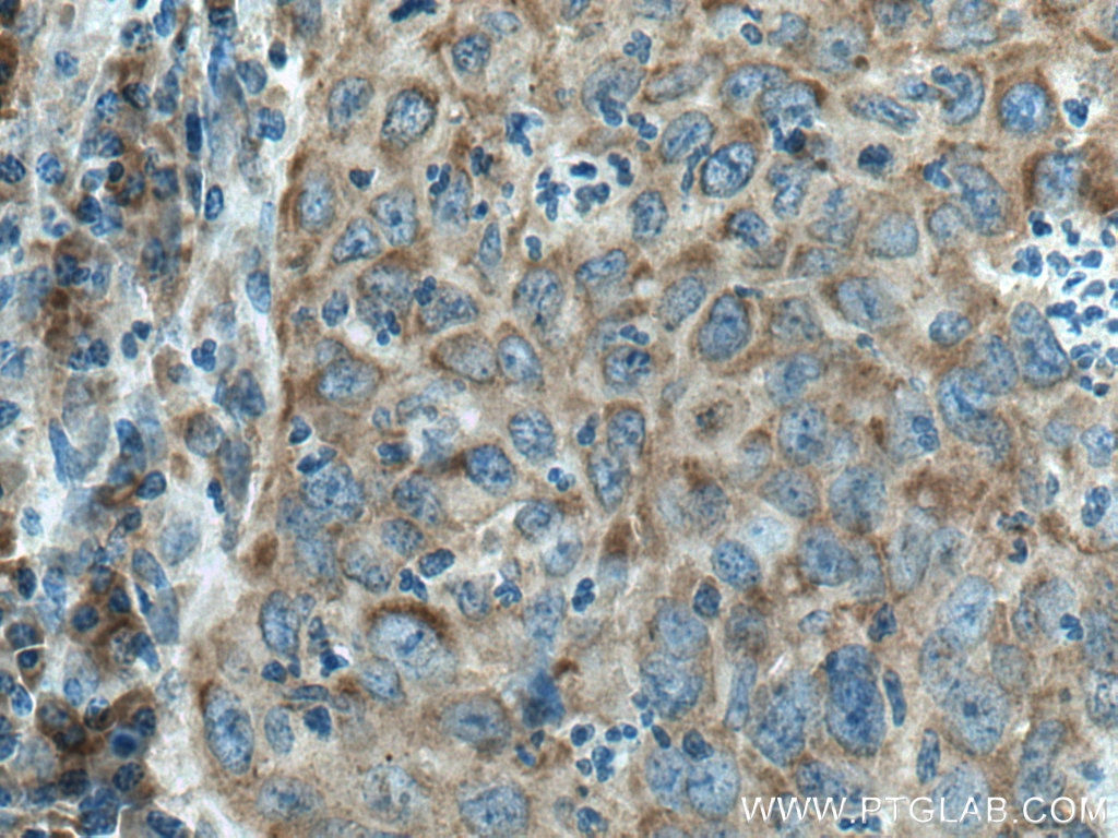 Immunohistochemistry (IHC) staining of human cervical cancer tissue using TRIM25 Monoclonal antibody (67314-1-Ig)