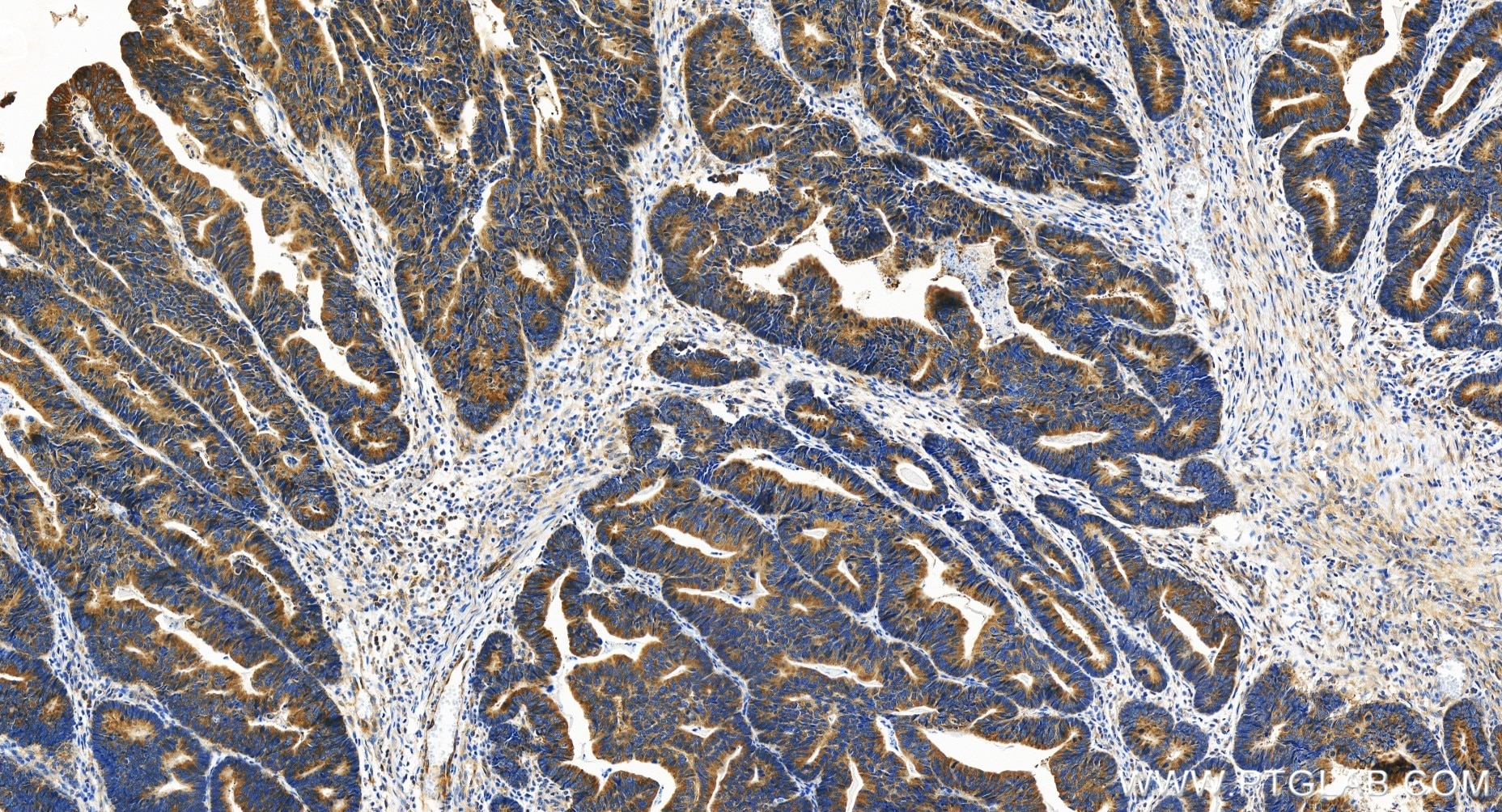 Immunohistochemistry (IHC) staining of human colon cancer tissue using TRIM25 Recombinant antibody (85919-1-RR)