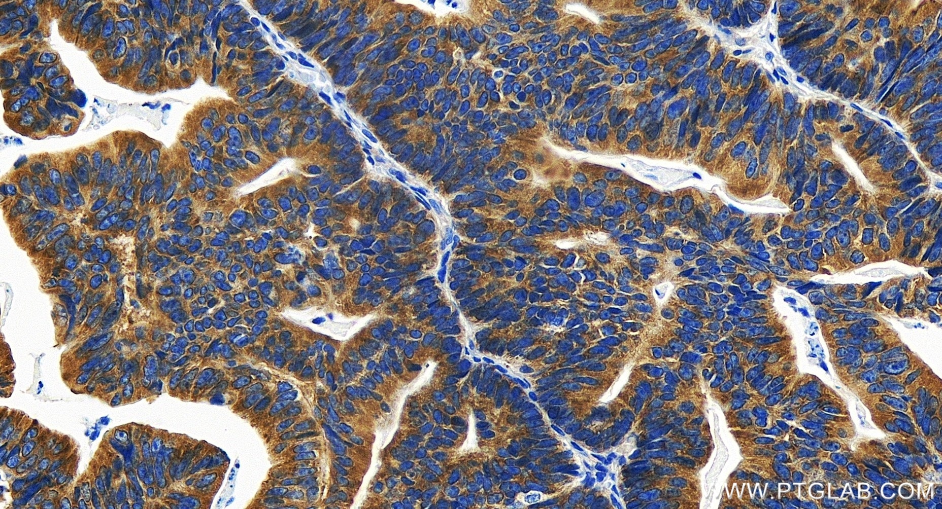 Immunohistochemistry (IHC) staining of human colon cancer tissue using TRIM25 Recombinant antibody (85919-1-RR)