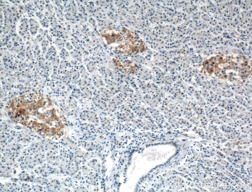 Immunohistochemistry (IHC) staining of human pancreas cancer tissue using TRIM26 Polyclonal antibody (27013-1-AP)