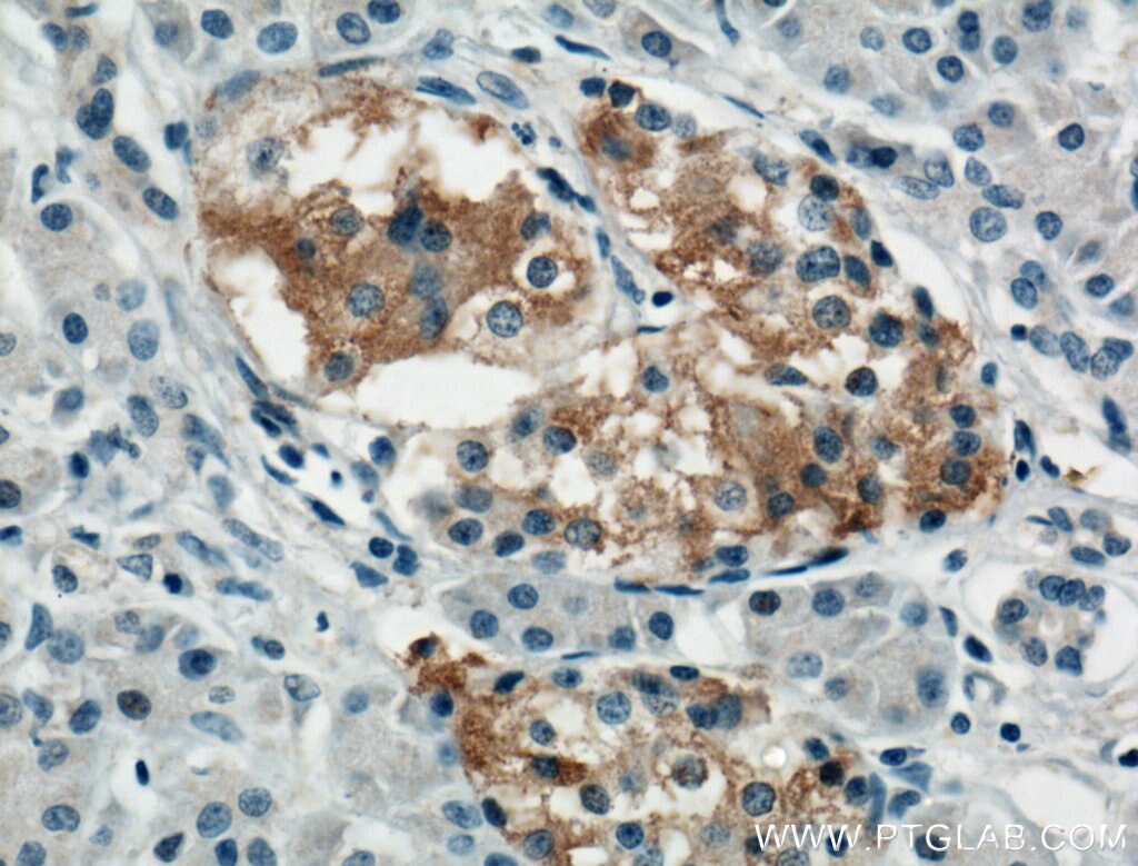 Immunohistochemistry (IHC) staining of human pancreas cancer tissue using TRIM26 Polyclonal antibody (27013-1-AP)