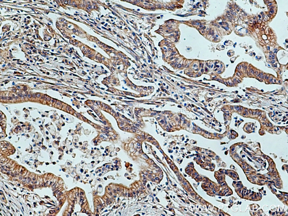 Immunohistochemistry (IHC) staining of human pancreas cancer tissue using TRIM26 Polyclonal antibody (27013-1-AP)