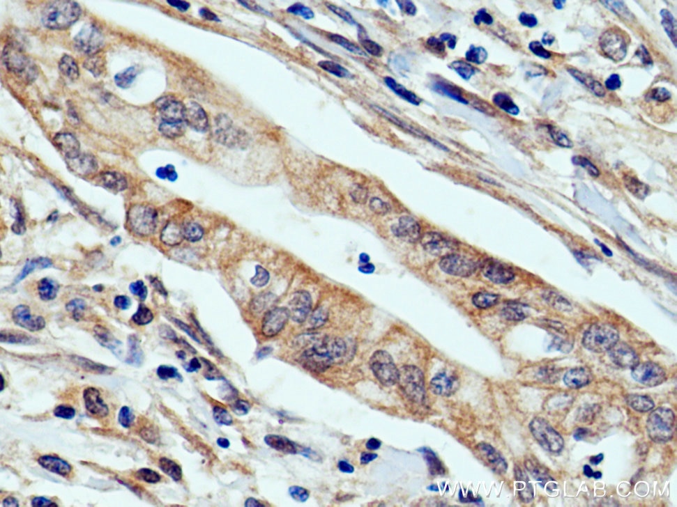 Immunohistochemistry (IHC) staining of human pancreas cancer tissue using TRIM26 Polyclonal antibody (27013-1-AP)
