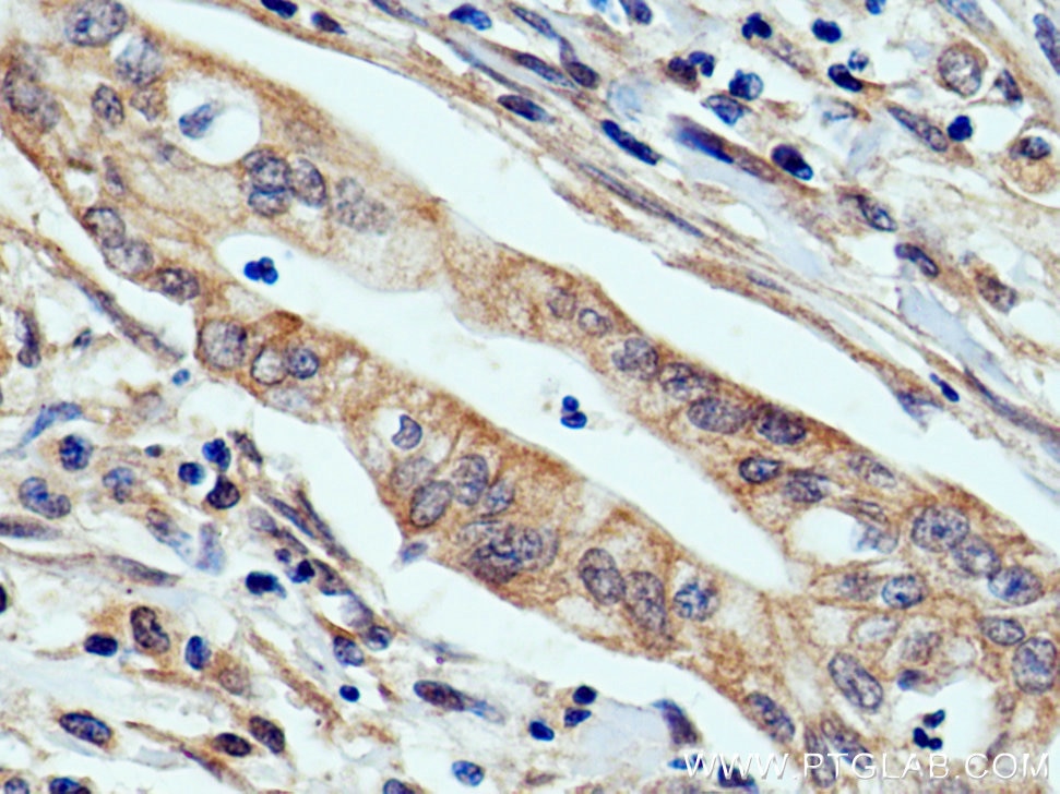 IHC staining of human pancreas cancer using 27013-1-AP