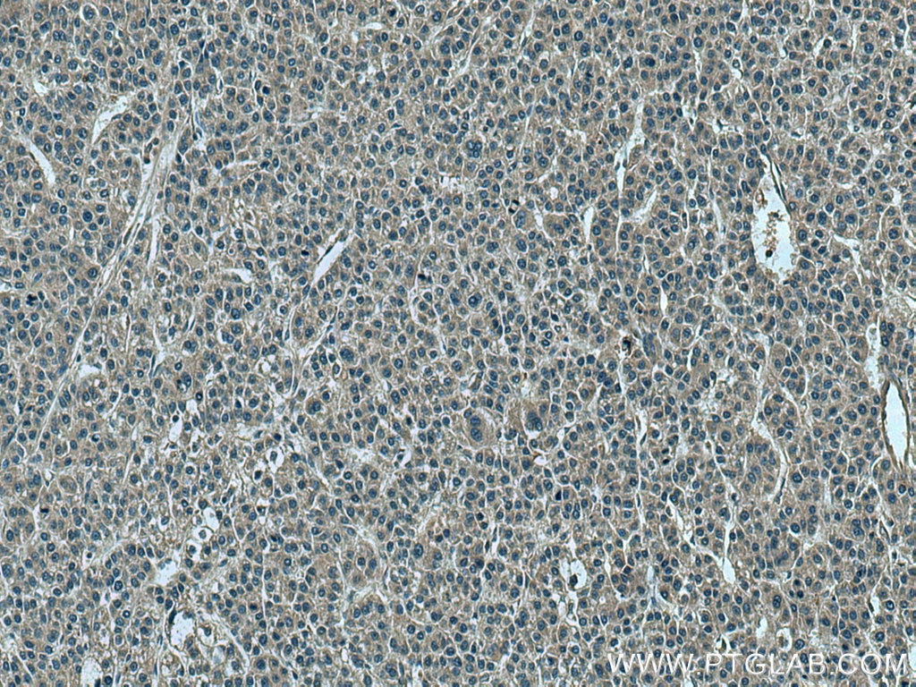 Immunohistochemistry (IHC) staining of human liver cancer tissue using TRIM26 Polyclonal antibody (27013-1-AP)