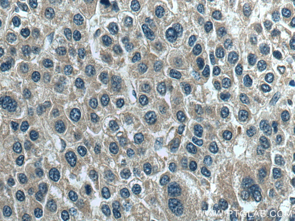 Immunohistochemistry (IHC) staining of human liver cancer tissue using TRIM26 Polyclonal antibody (27013-1-AP)