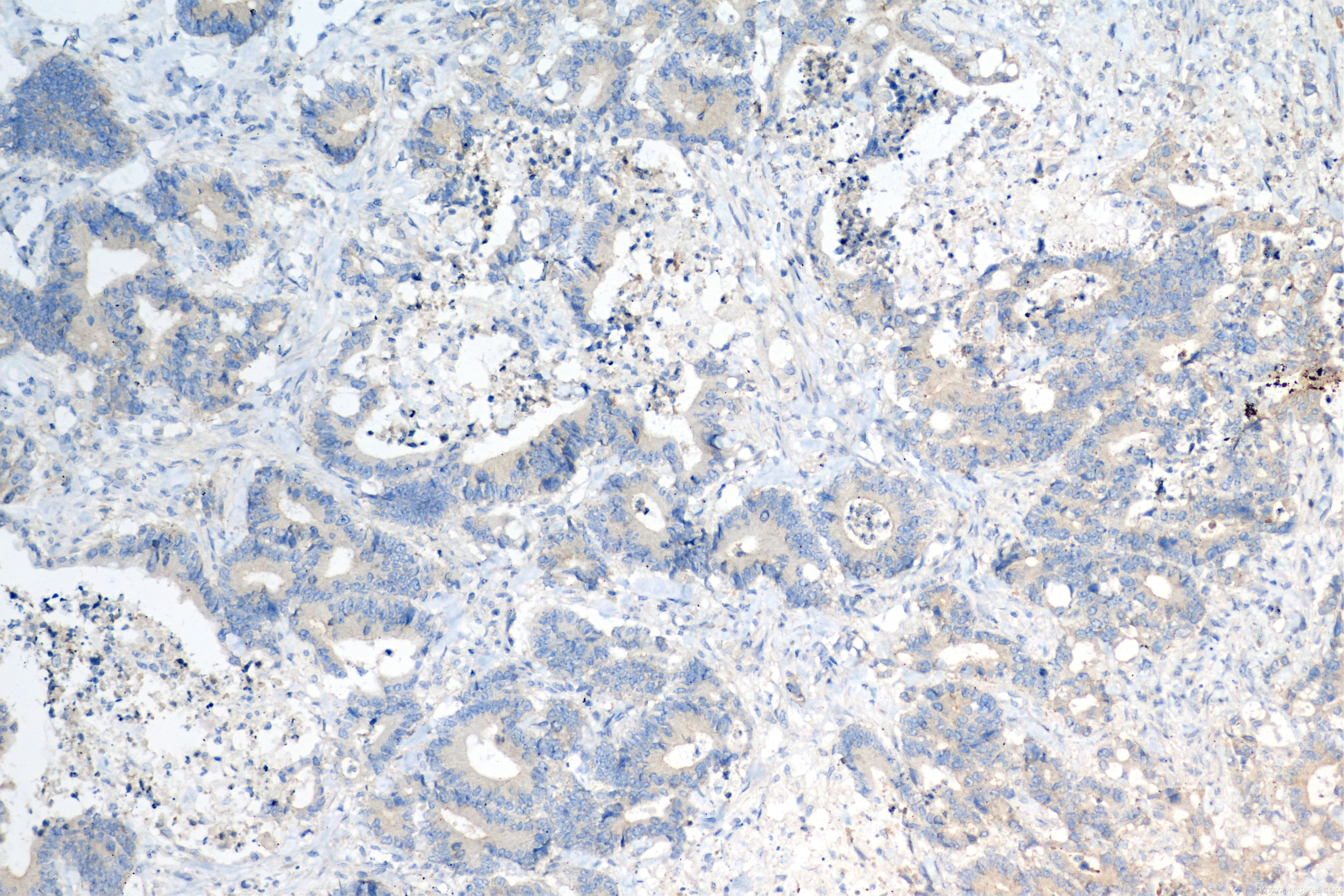 Immunohistochemistry (IHC) staining of human rectal cancer tissue using TRIM26 Recombinant antibody (84661-4-RR)