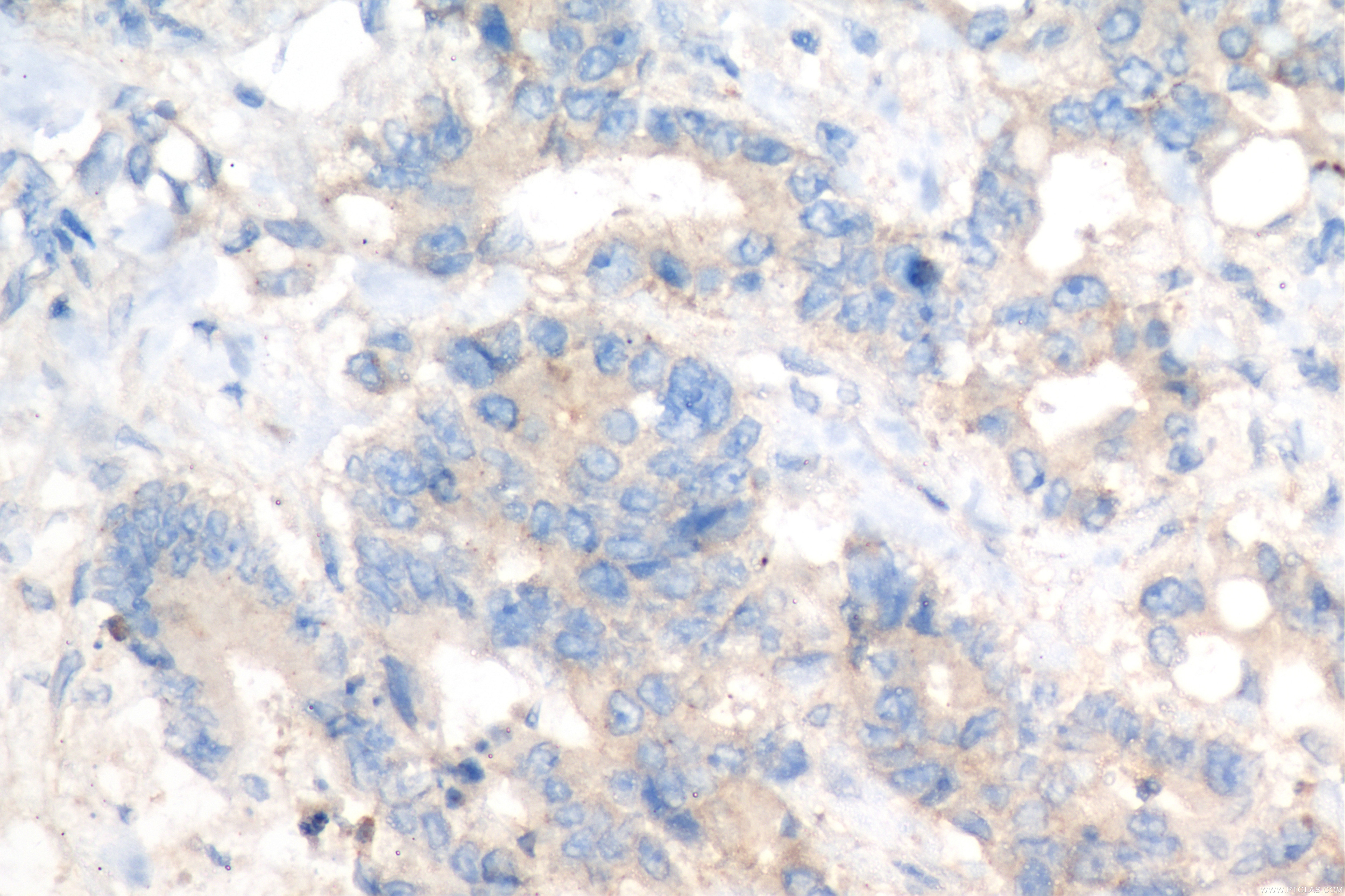 Immunohistochemistry (IHC) staining of human rectal cancer tissue using TRIM26 Recombinant antibody (84661-4-RR)
