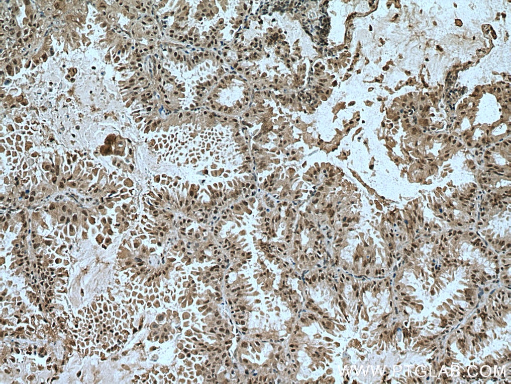 Immunohistochemistry (IHC) staining of human lung cancer tissue using TRIM27 Polyclonal antibody (12205-1-AP)