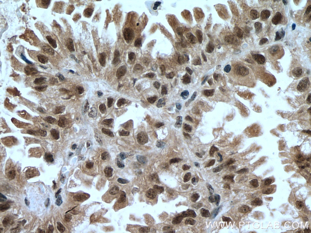 Immunohistochemistry (IHC) staining of human lung cancer tissue using TRIM27 Polyclonal antibody (12205-1-AP)