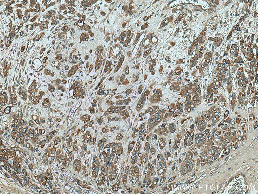 Immunohistochemistry (IHC) staining of human colon cancer tissue using TRIM27 Polyclonal antibody (28751-1-AP)