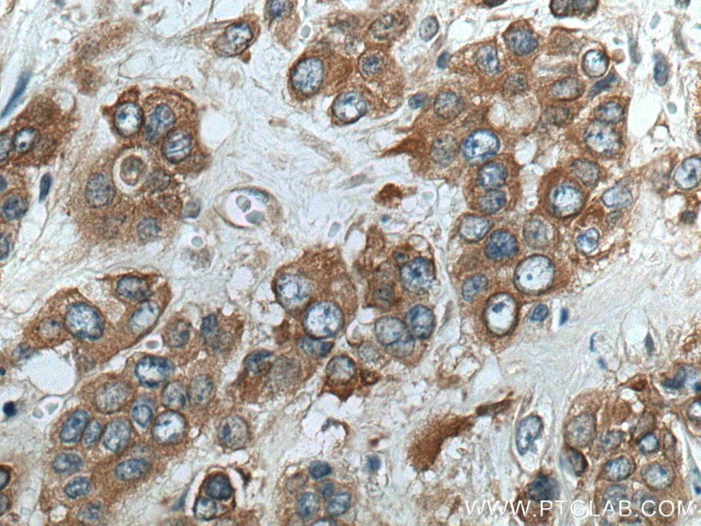 Immunohistochemistry (IHC) staining of human colon cancer tissue using TRIM27 Polyclonal antibody (28751-1-AP)