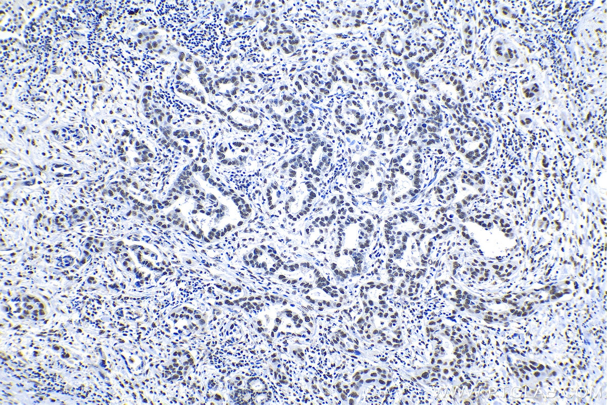 Immunohistochemistry (IHC) staining of human lung cancer tissue using KAP1 Polyclonal antibody (15202-1-AP)