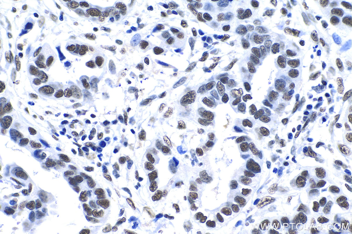 Immunohistochemistry (IHC) staining of human lung cancer tissue using KAP1 Polyclonal antibody (15202-1-AP)