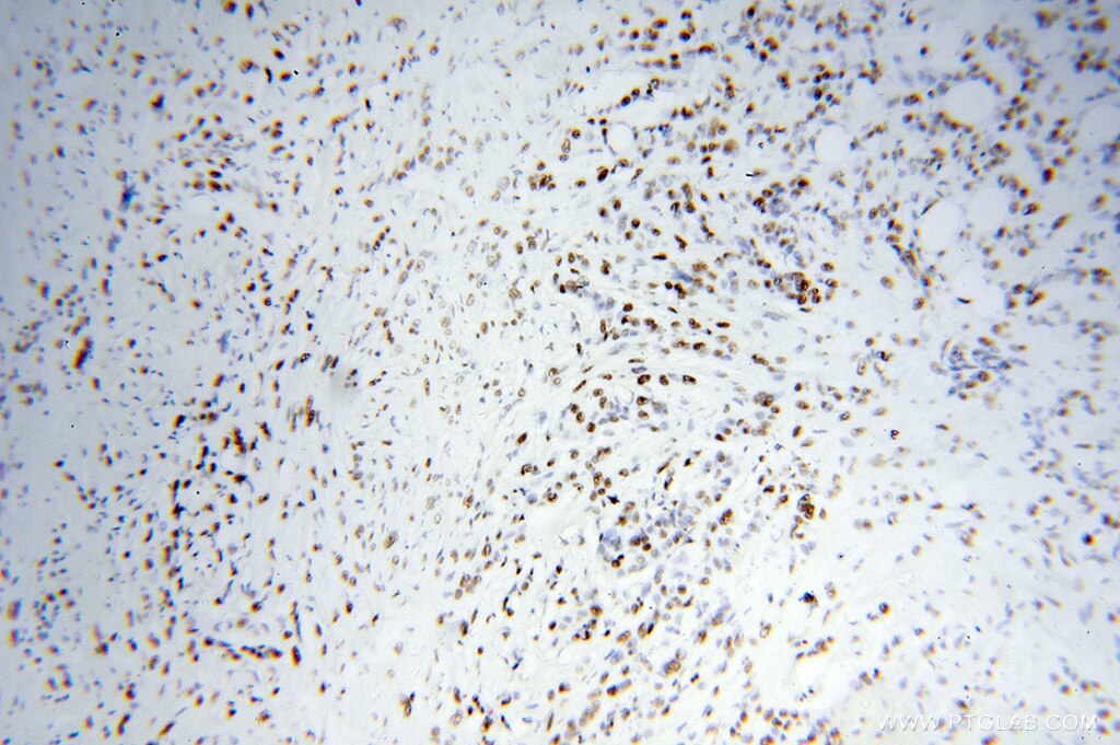 IHC staining of human colon cancer using 15202-1-AP