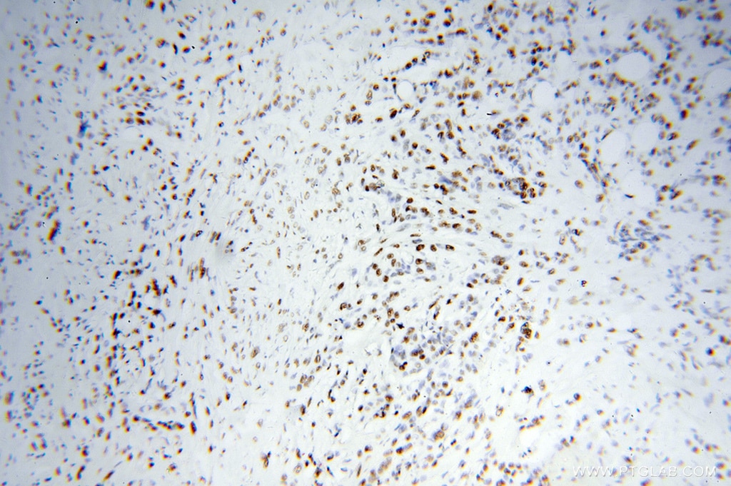 Immunohistochemistry (IHC) staining of human colon cancer tissue using KAP1 Polyclonal antibody (15202-1-AP)