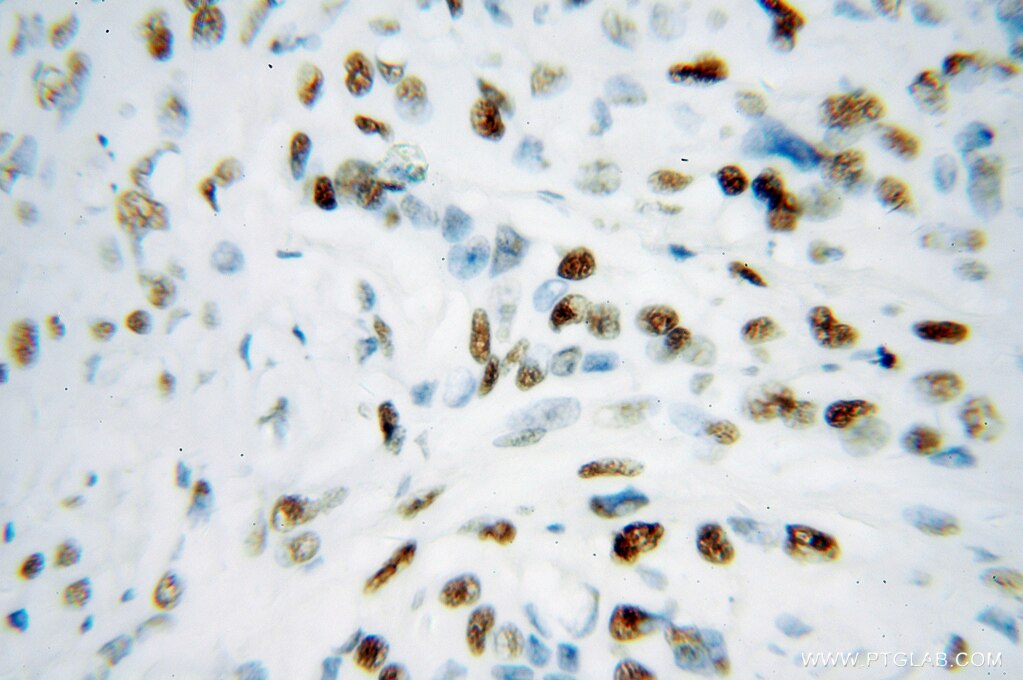 Immunohistochemistry (IHC) staining of human colon cancer tissue using KAP1 Polyclonal antibody (15202-1-AP)
