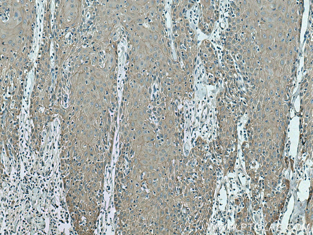 IHC staining of human skin cancer using 17542-1-AP