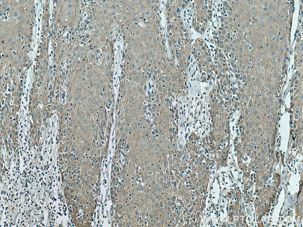 Immunohistochemistry (IHC) staining of human skin cancer tissue using TRIM29 Polyclonal antibody (17542-1-AP)