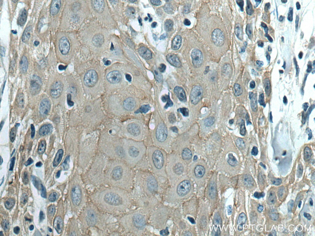 Immunohistochemistry (IHC) staining of human skin cancer tissue using TRIM29 Polyclonal antibody (17542-1-AP)